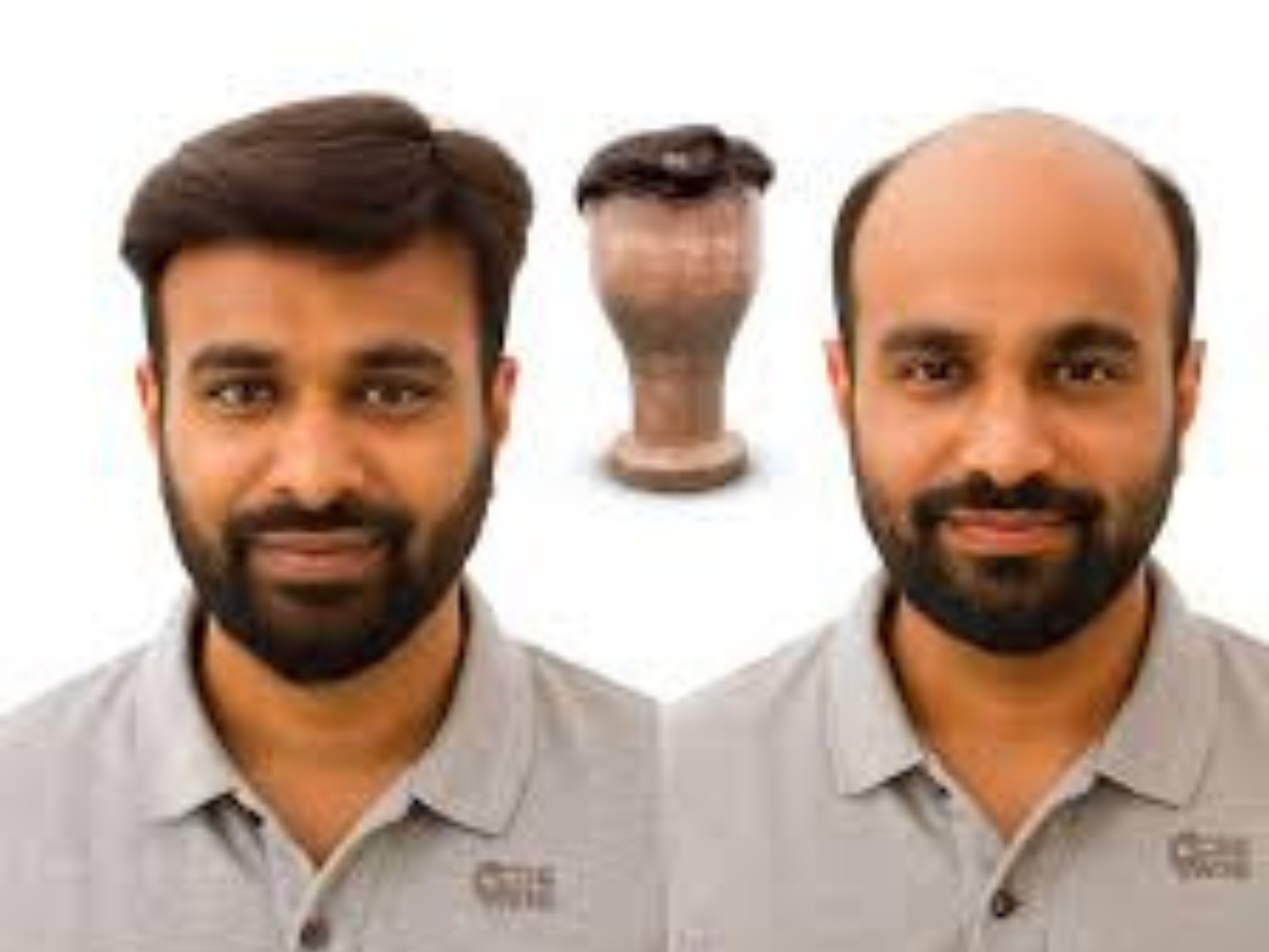 hair patch in hyderabad