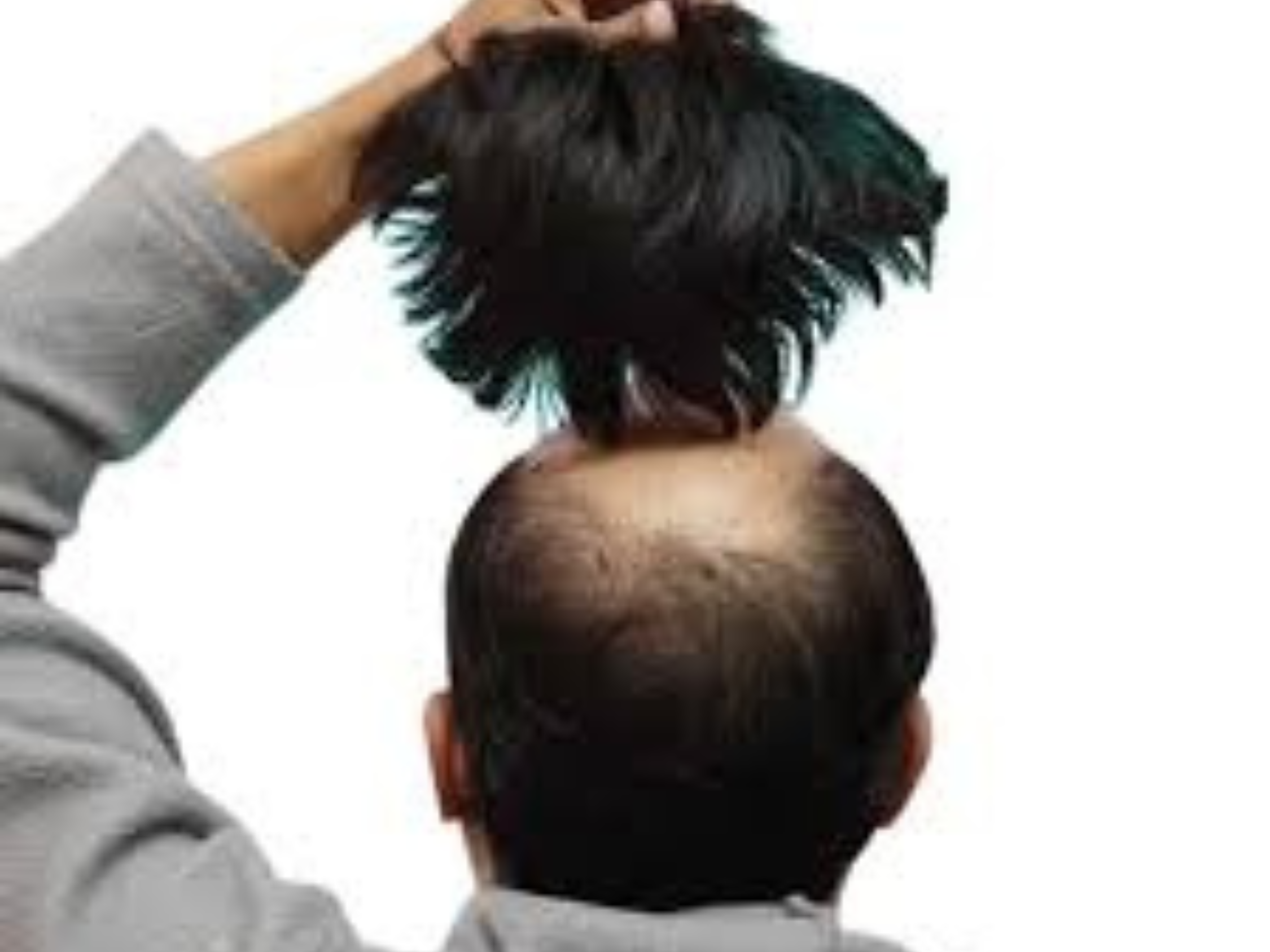Best Hair Patch Services in Hyderabad