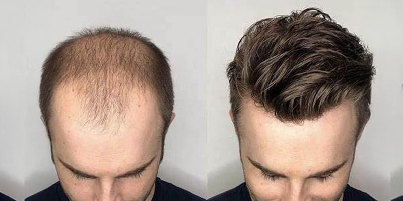 Side-by-side image of a man’s scalp showing significant hair thinning on the left and fuller, thicker hair on the right.
