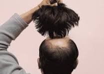 Hair patch fixing for baldness in Hyderabad