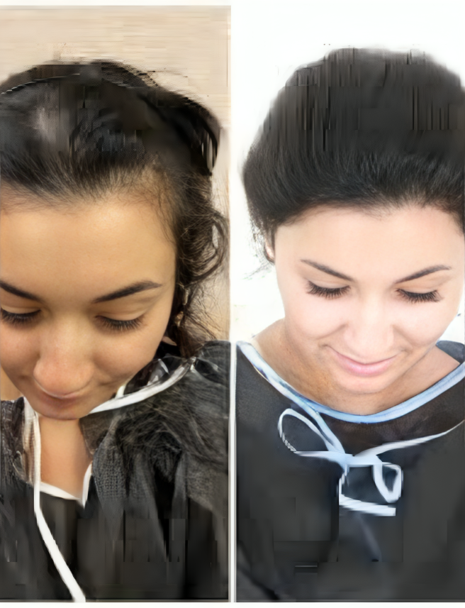 Before and after female hairline restoration showing thinning scalp and improved hair density