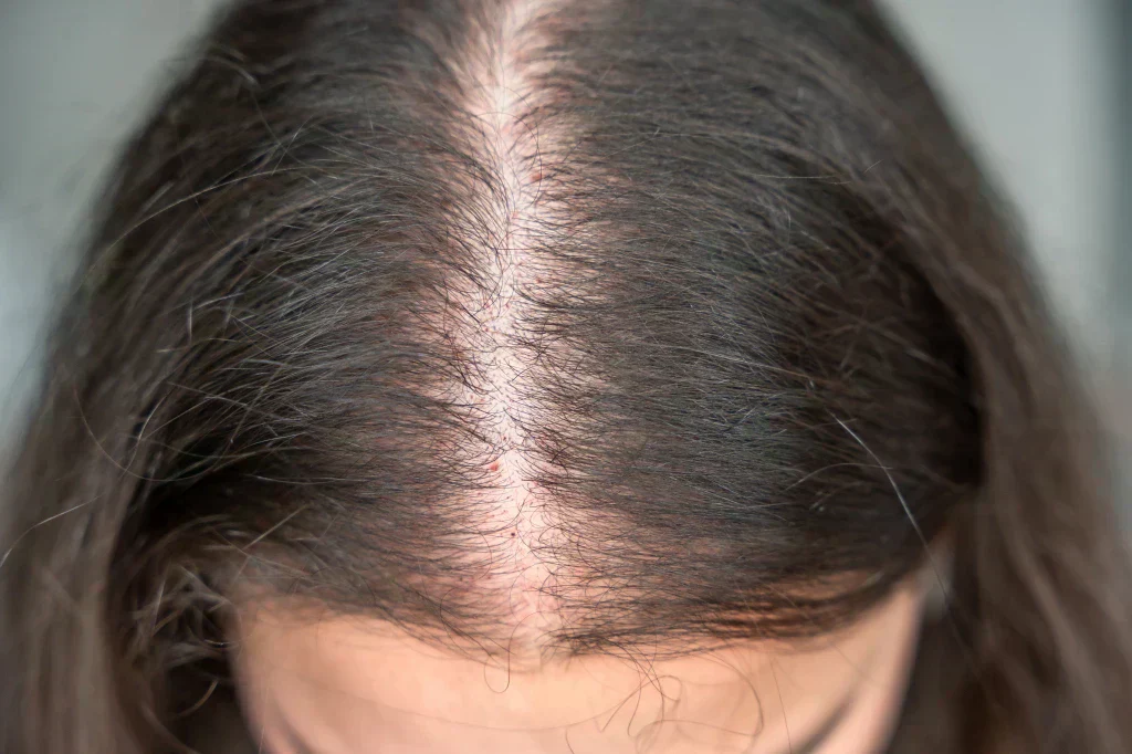 Top view of a person’s scalp showing visible hair thinning along the center part.