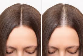 Early signs of hair thinning in men and women, showing hair loss patterns and scalp visibility
