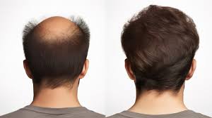 Back view of a man's head in a side-by-side comparison. The left side shows advanced balding on the crown and vertex; the right side shows a full head of thick, dark hair following a hair restoration procedure.