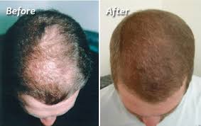 A side-by-side comparison of a man’s scalp showing significant hair regrowth. The left image shows thinning hair and a visible bald spot on the crown; the right image shows a full, thick head of hair after treatment.