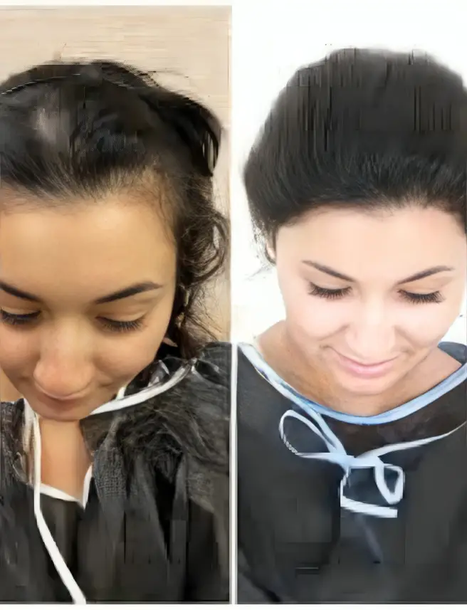 Before and after female hairline restoration showing thinning scalp and improved hair density