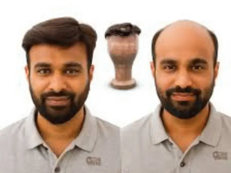 hair patch in hyderabad