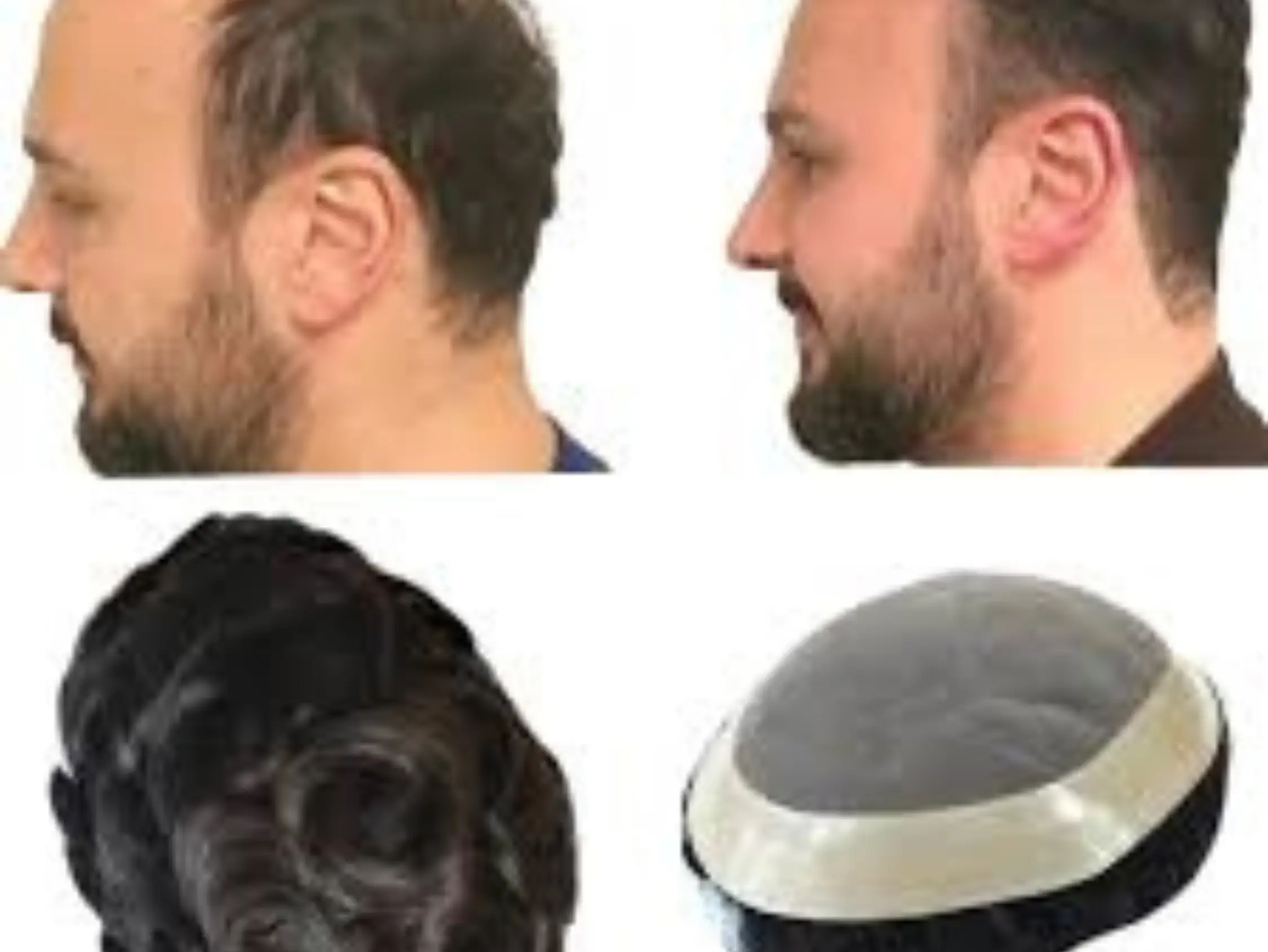 Choosing the best hair patch services in hyderabad